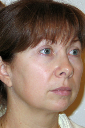 Комлексное омоложение лица